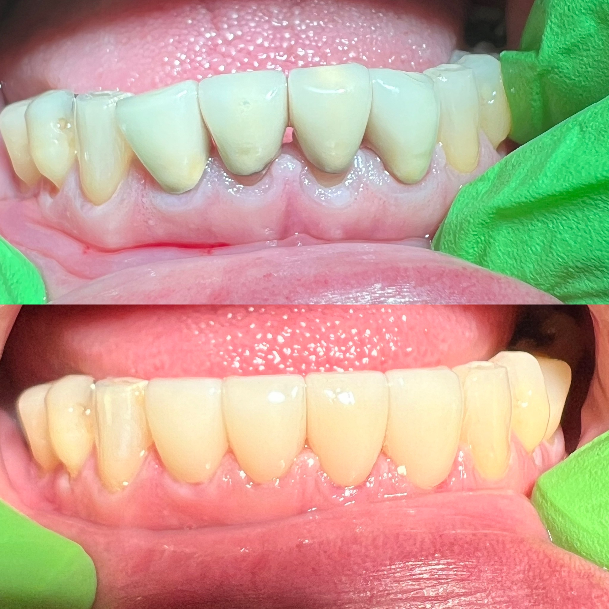 Esthetic Zirconia Crowns Replacing PFM Metal Crowns